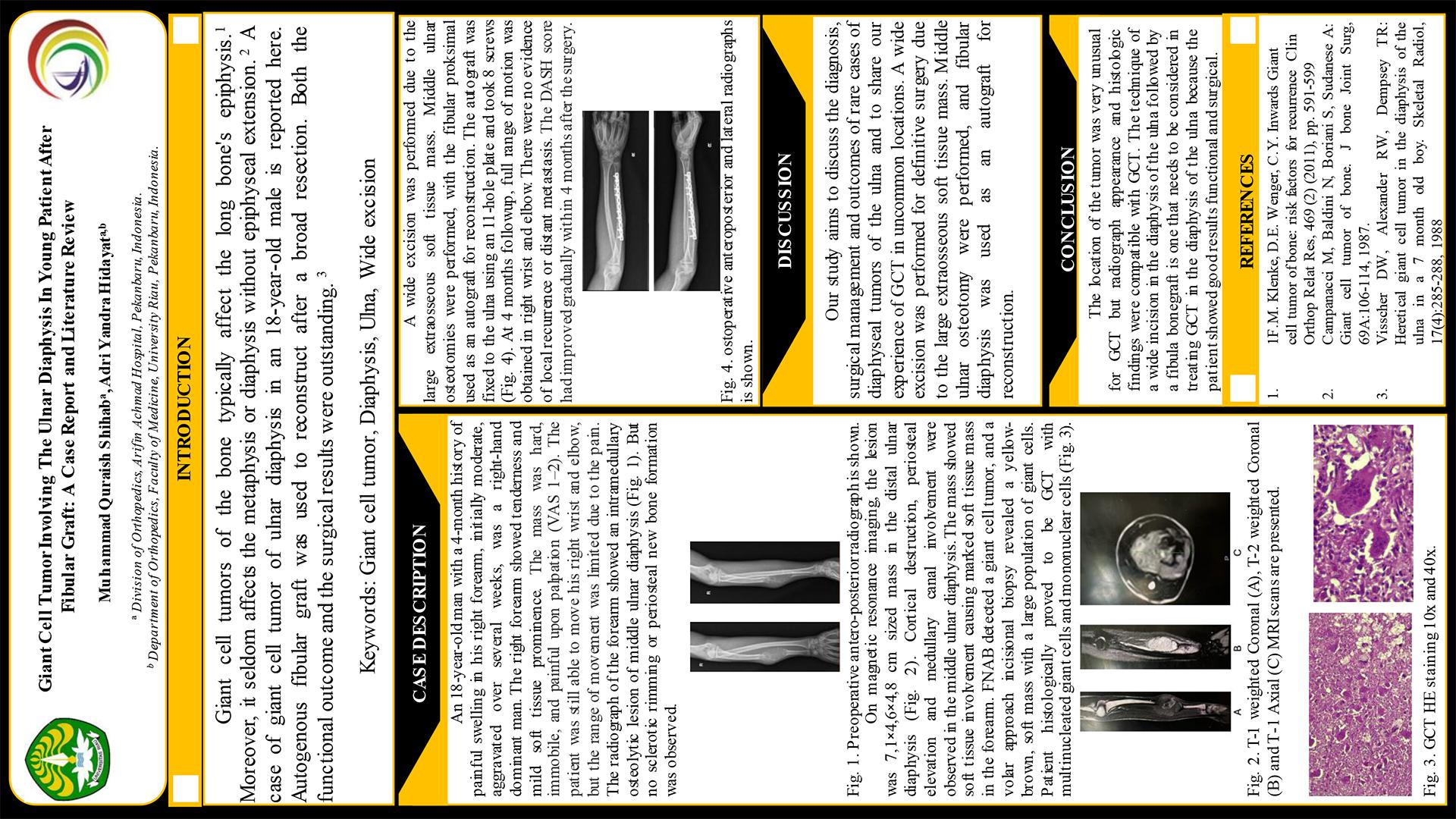 Giant Cell Tumor Involving The Ulnar Diaphysis In Young Patient After Fibular Graft: A Case Report and Literature Review